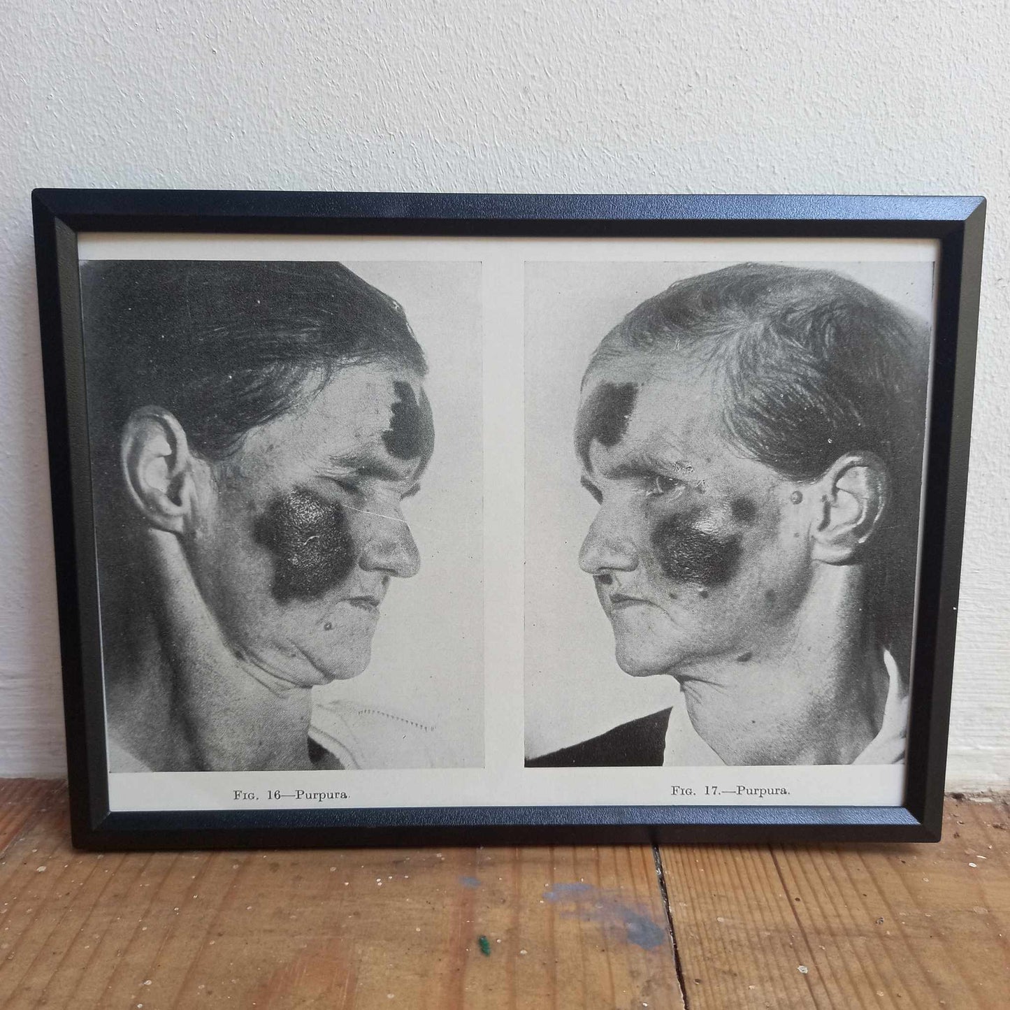Framed Pages from an antique book on Skin Diseases