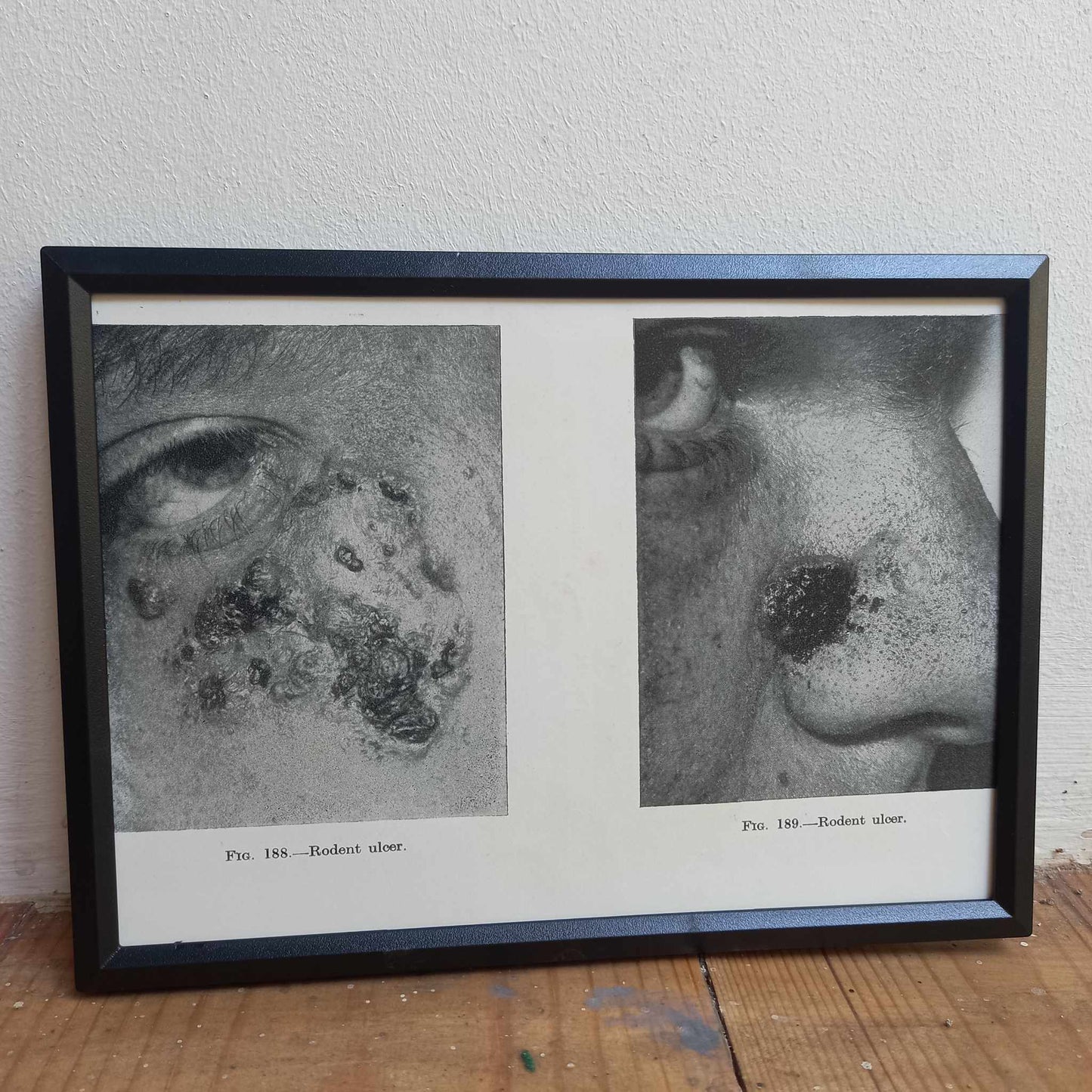 Framed Pages from an antique book on Skin Diseases