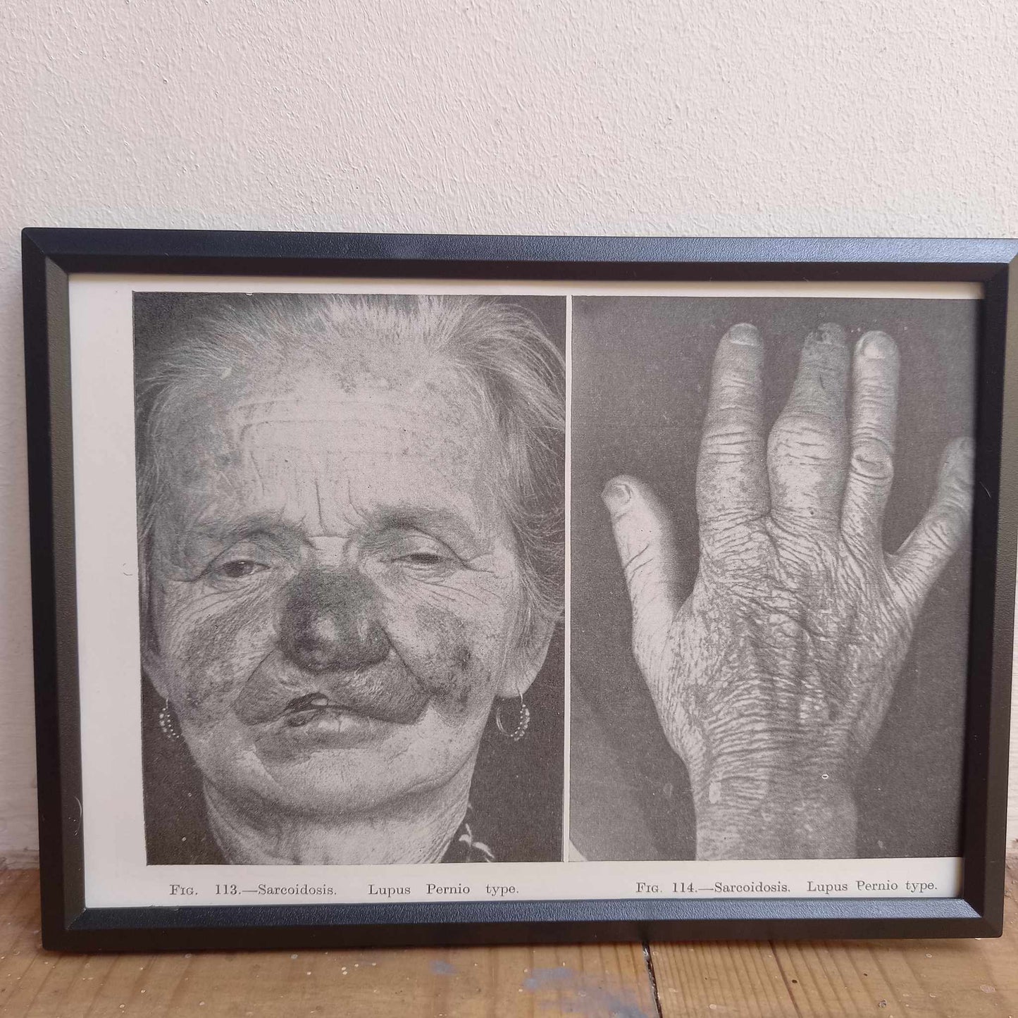 Framed Pages from an antique book on Skin Diseases
