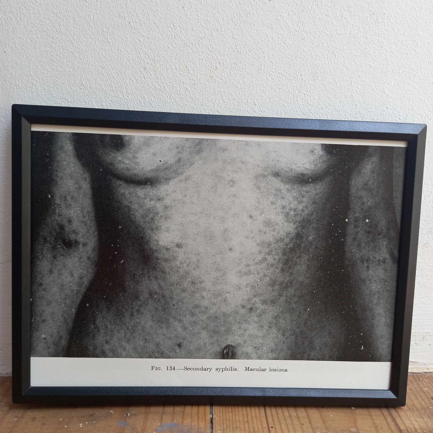 Framed Pages from an antique book on Skin Diseases