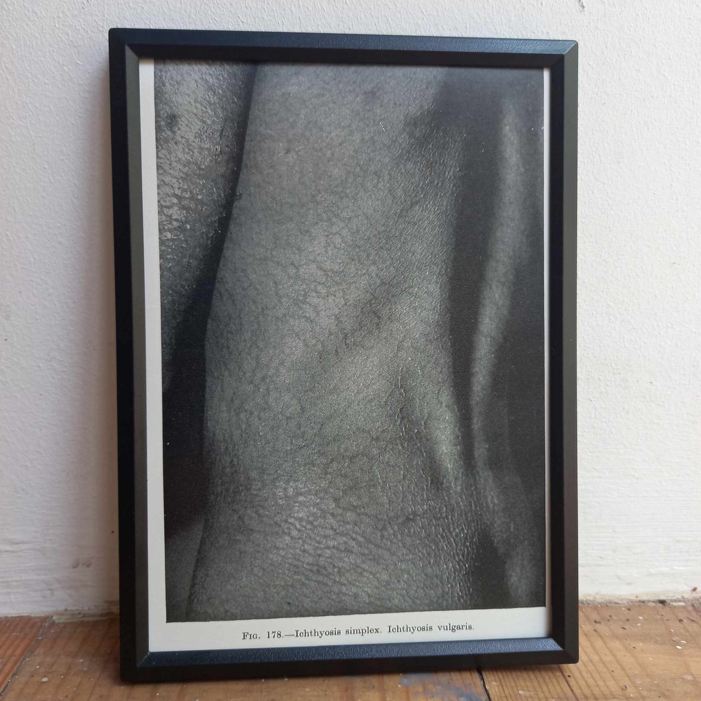 Framed Pages from an antique book on Skin Diseases