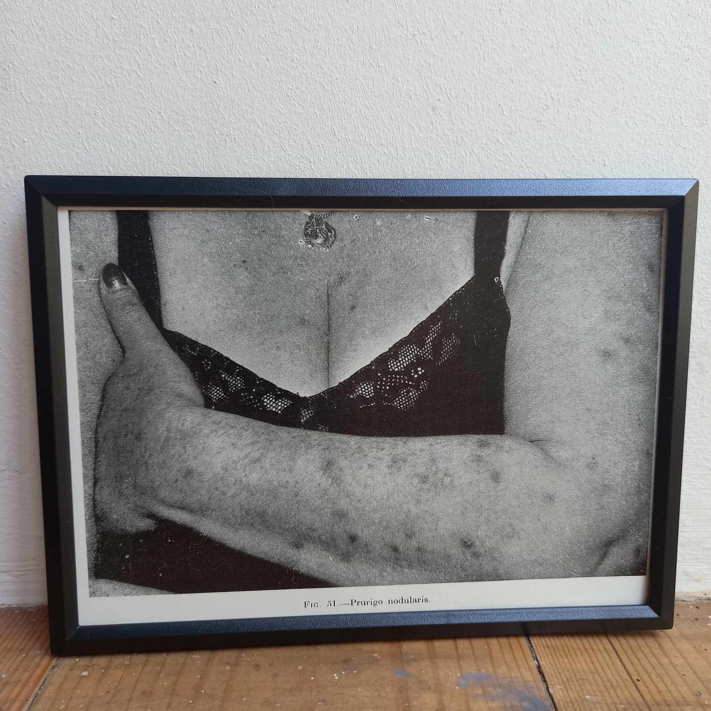Framed Pages from an antique book on Skin Diseases