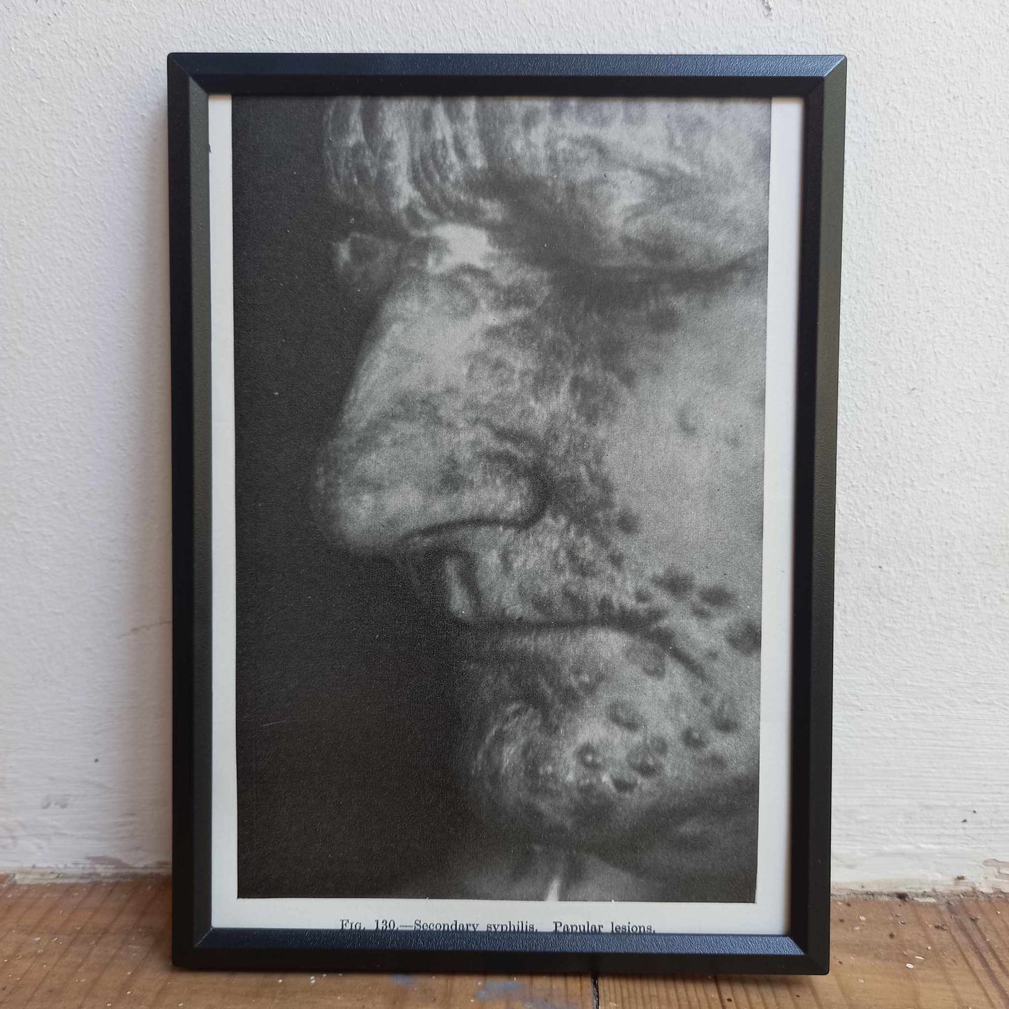 Framed Pages from an antique book on Skin Diseases