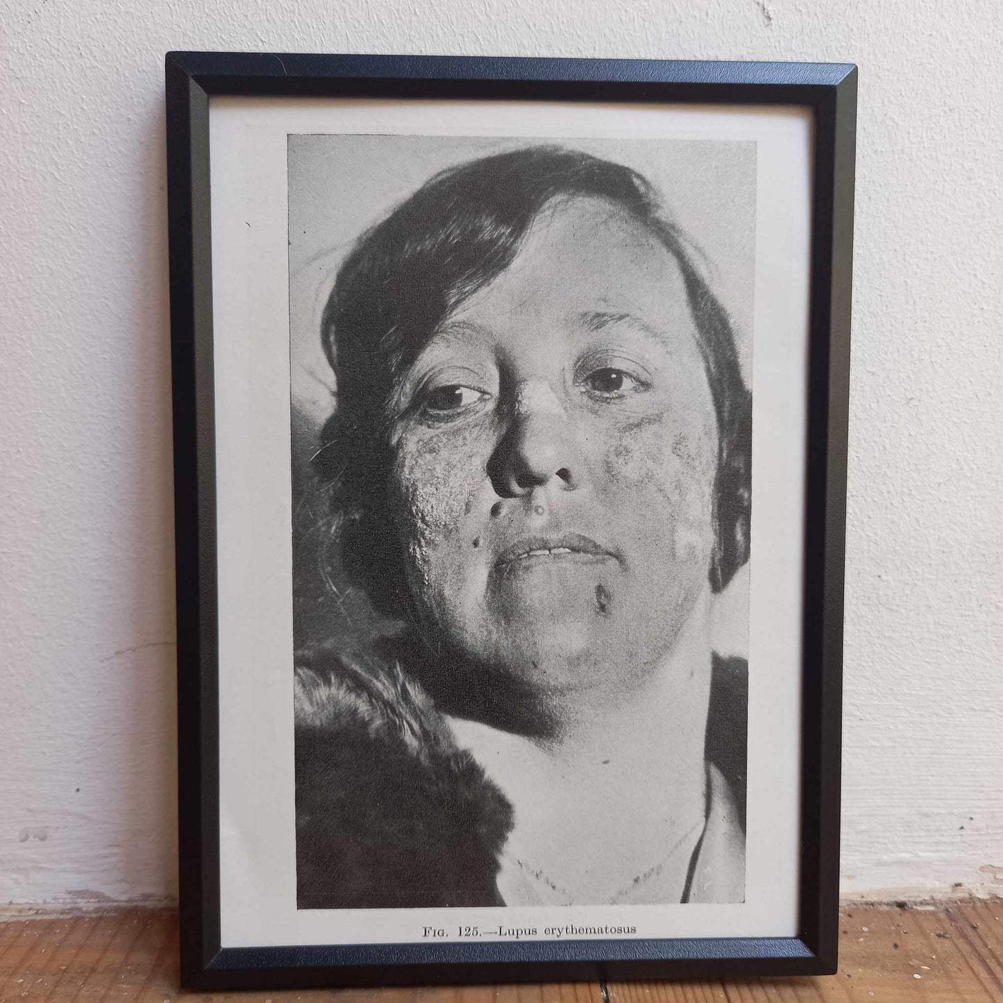 Framed Pages from an antique book on Skin Diseases