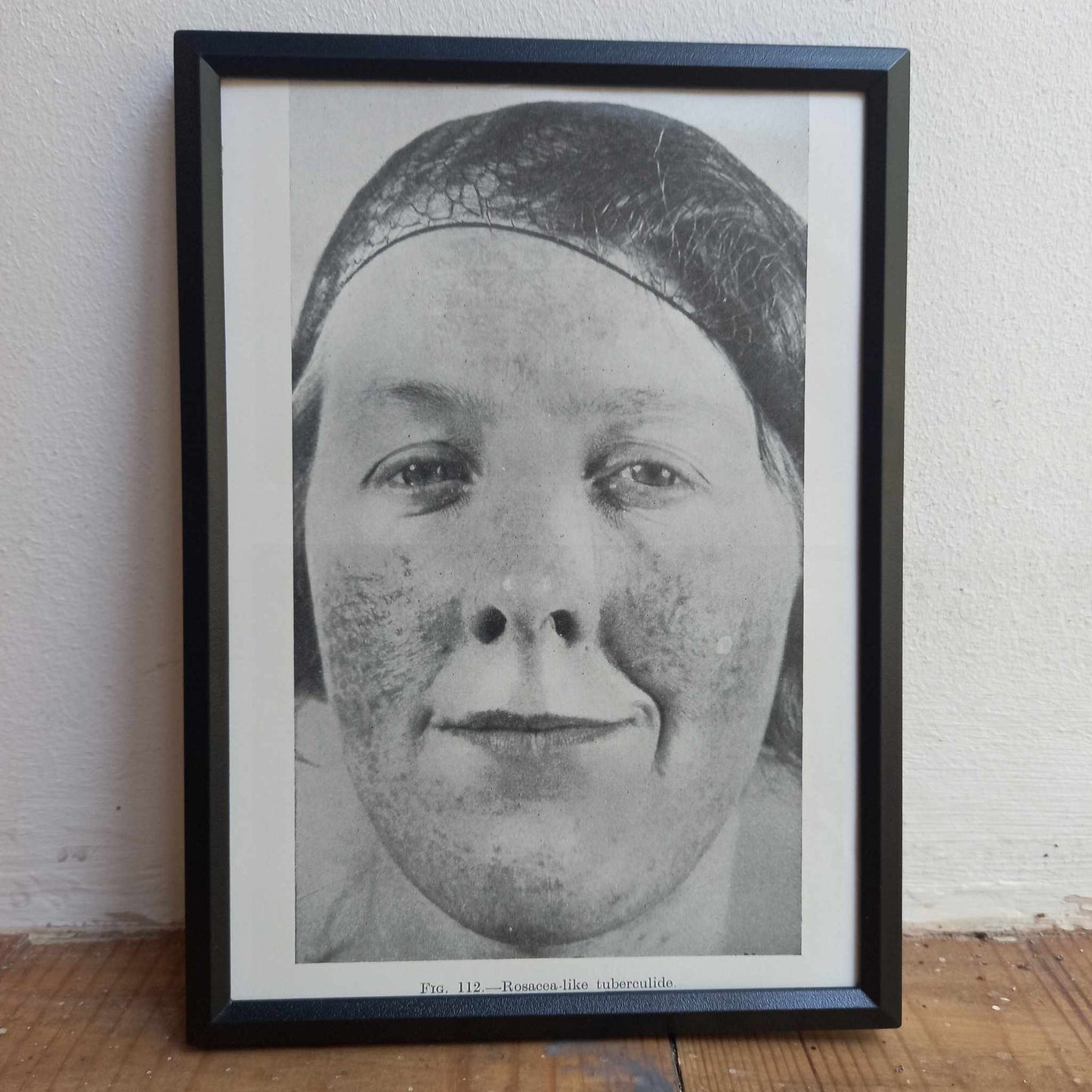 Framed Pages from an antique book on Skin Diseases