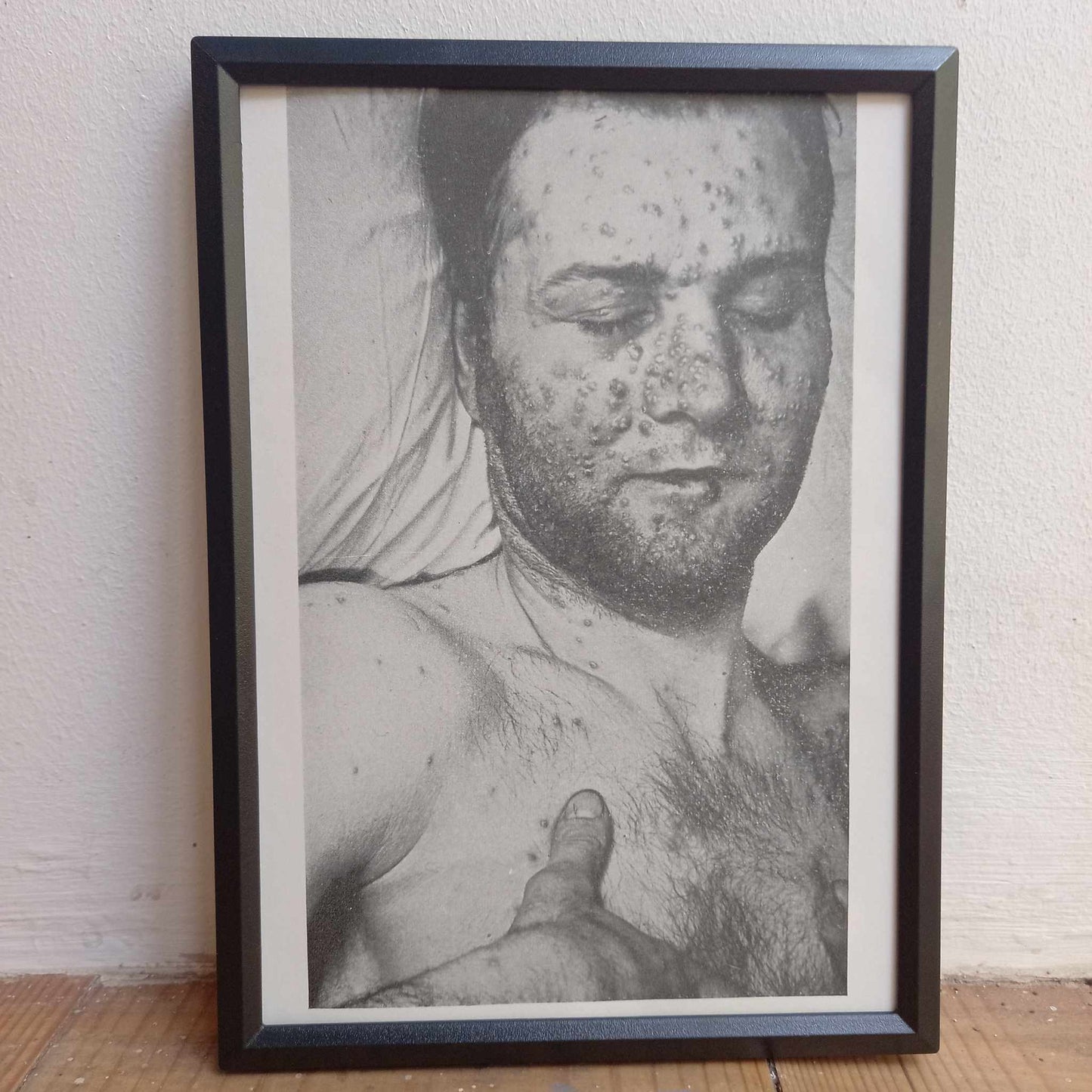 Framed Pages from an antique book on Skin Diseases