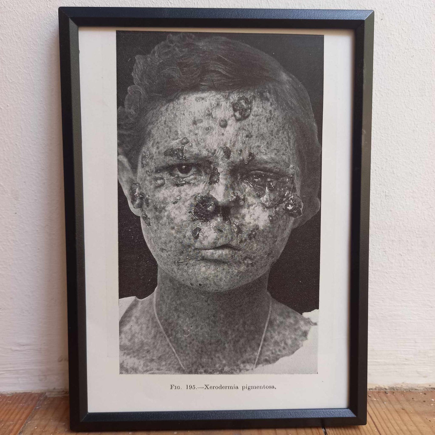 Framed Pages from an antique book on Skin Diseases