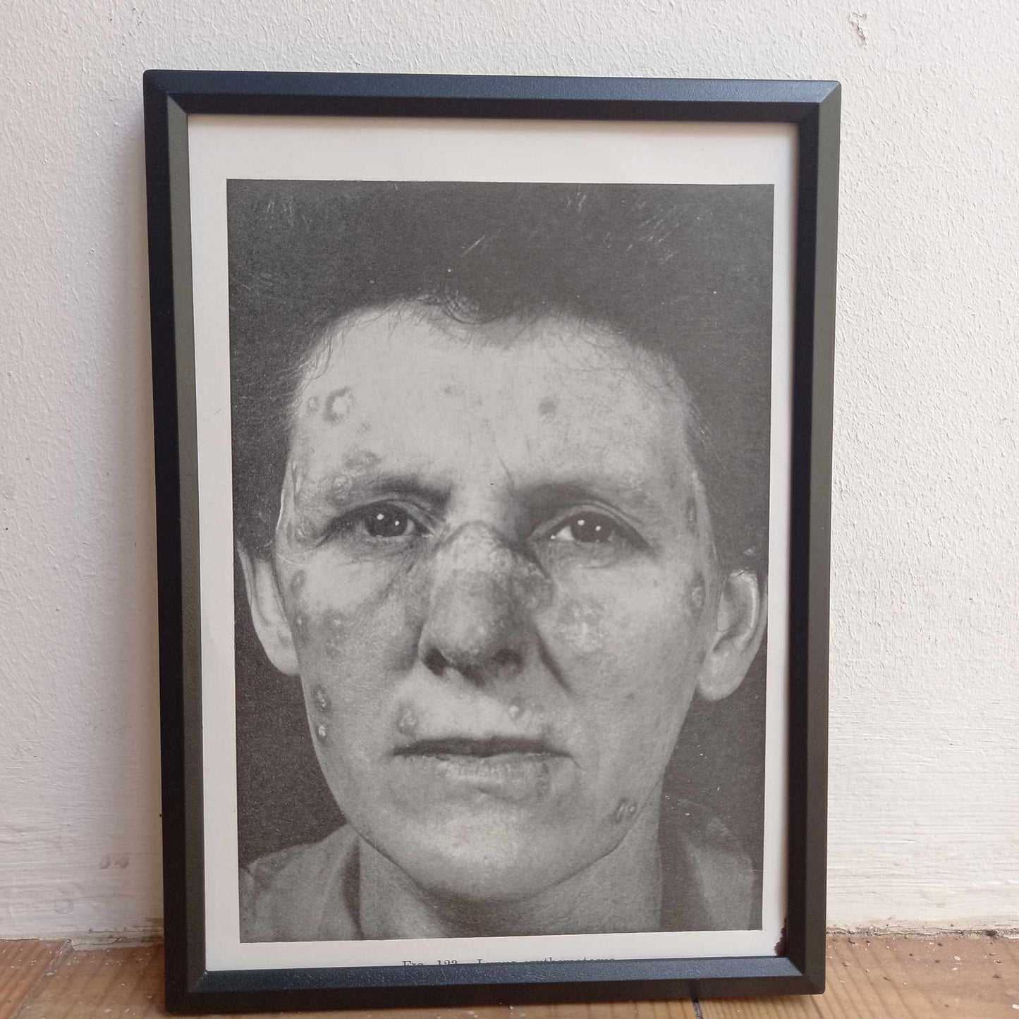 Framed Pages from an antique book on Skin Diseases