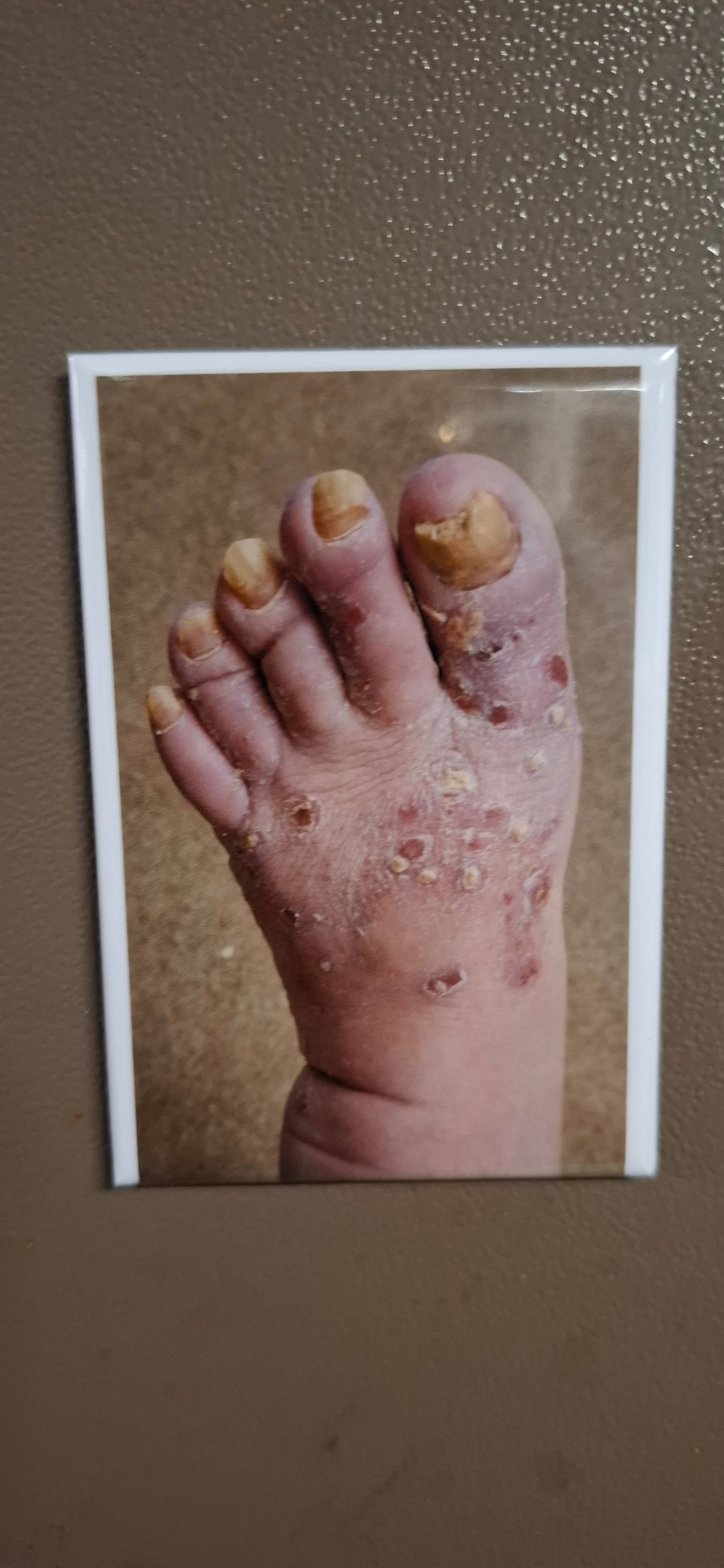 My Dad's Toes 2025 Update - Fridge Magnet