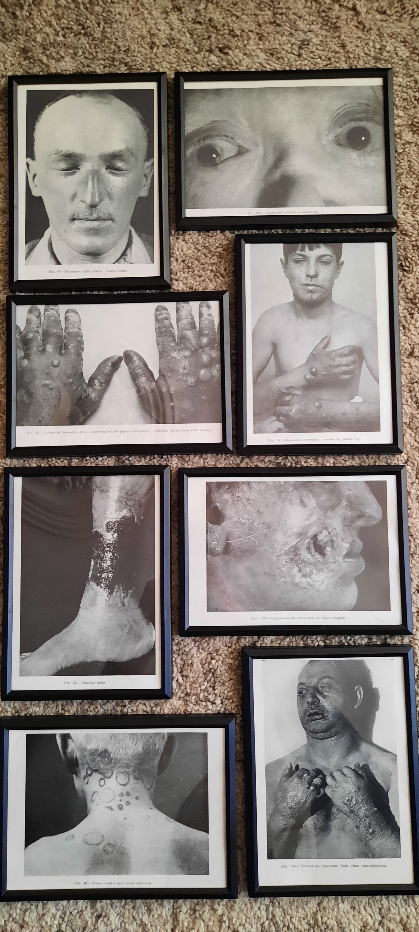 Framed Pages from an antique book on Skin Diseases
