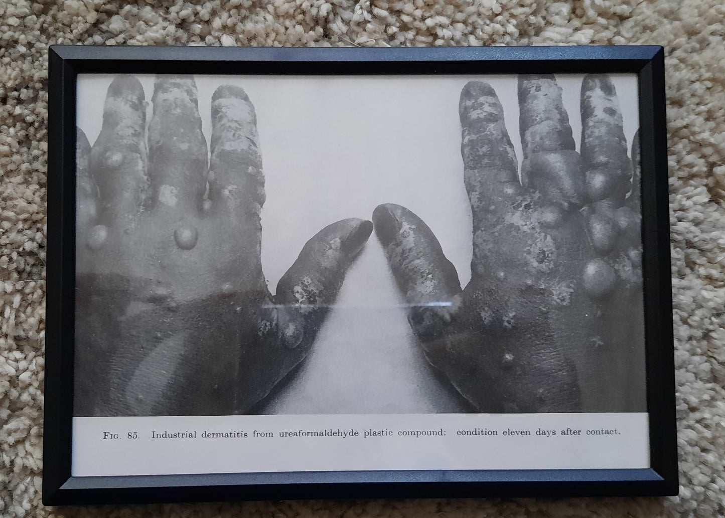 Framed Pages from an antique book on Skin Diseases