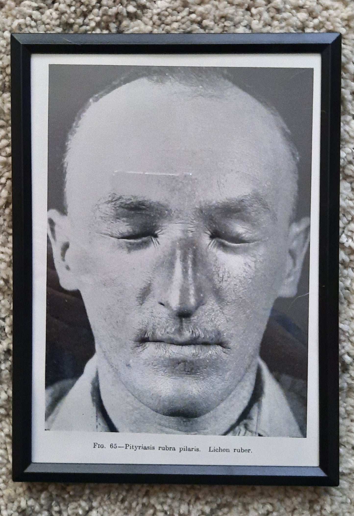 Framed Pages from an antique book on Skin Diseases