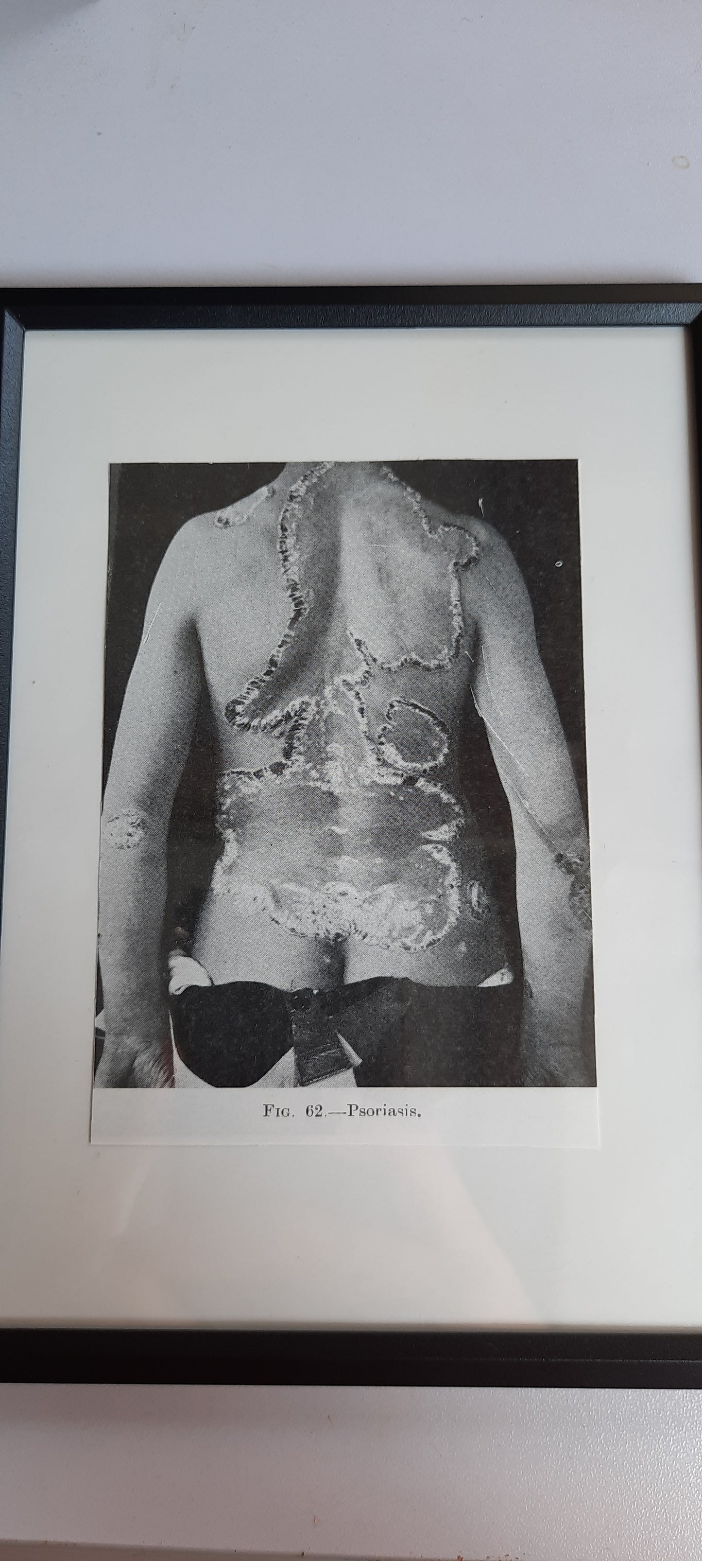 Framed Pages from an antique book on Skin Diseases
