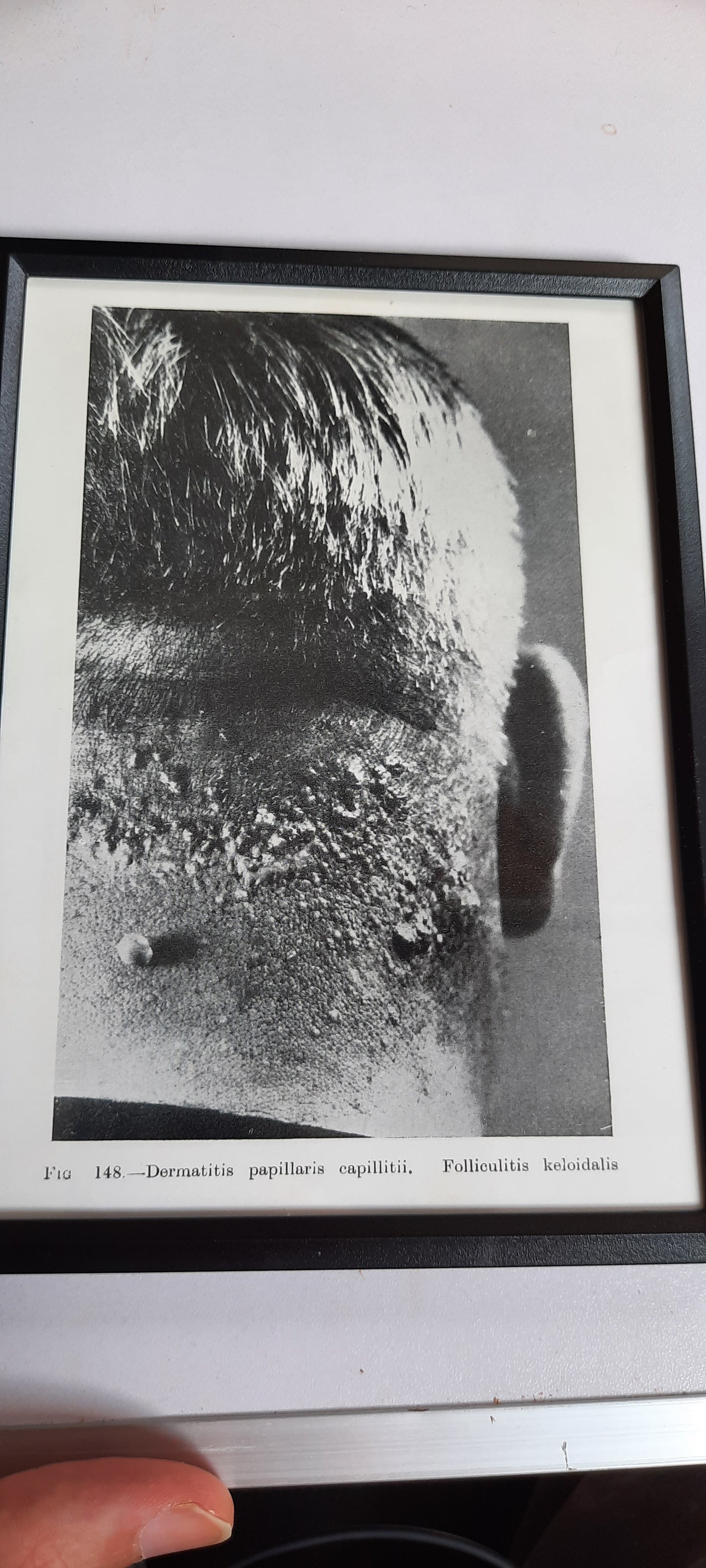 Framed Pages from an antique book on Skin Diseases
