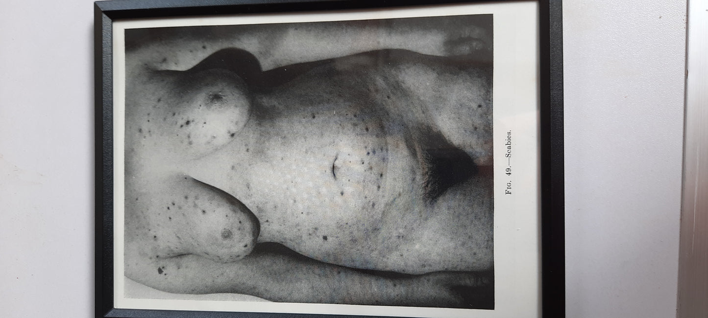 Framed Pages from an antique book on Skin Diseases