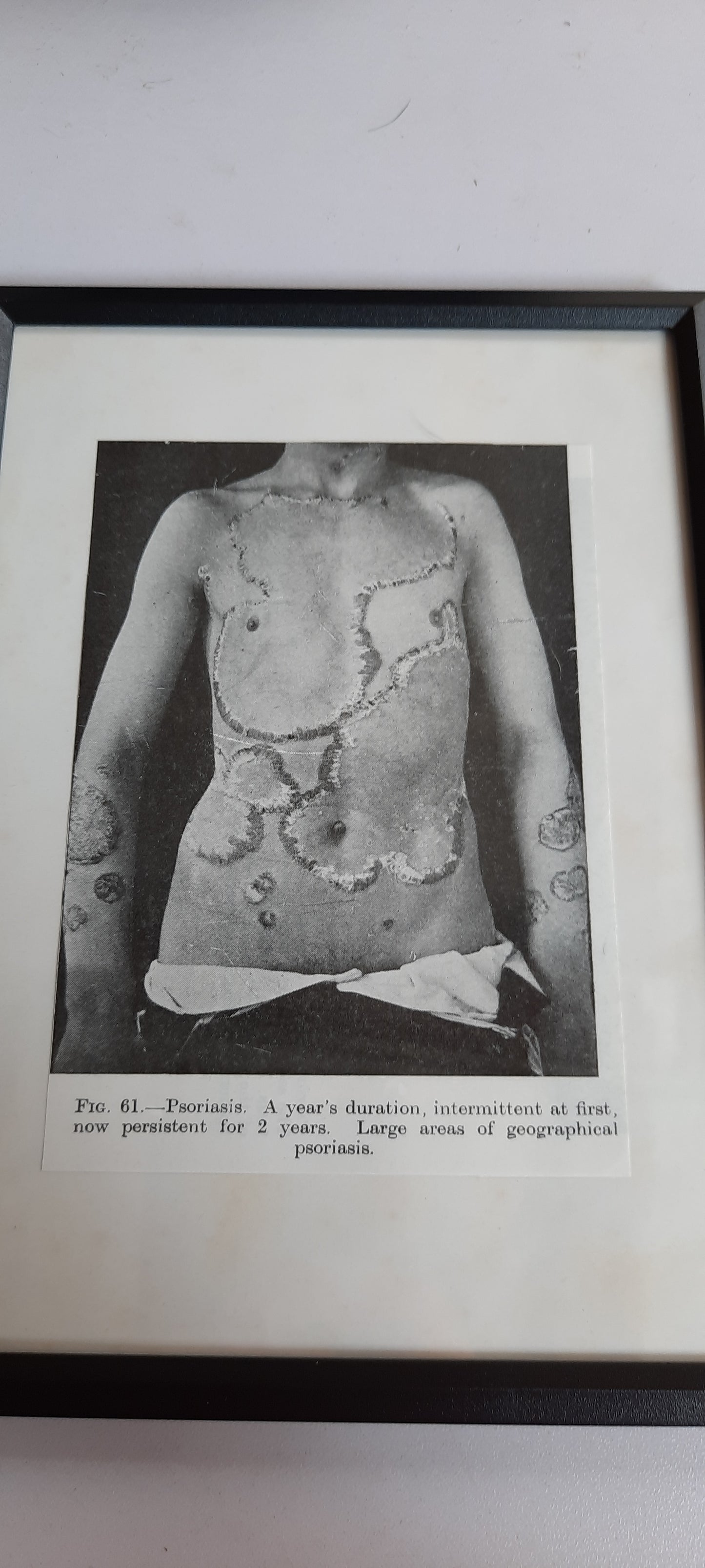 Framed Pages from an antique book on Skin Diseases