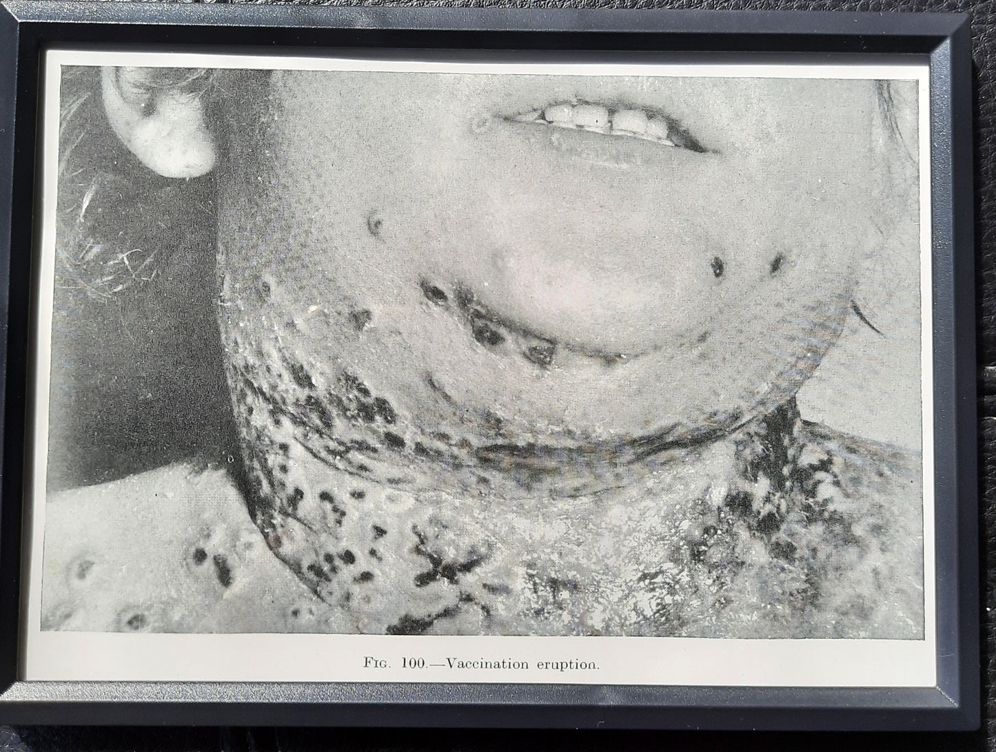 Framed Pages from an antique book on Skin Diseases