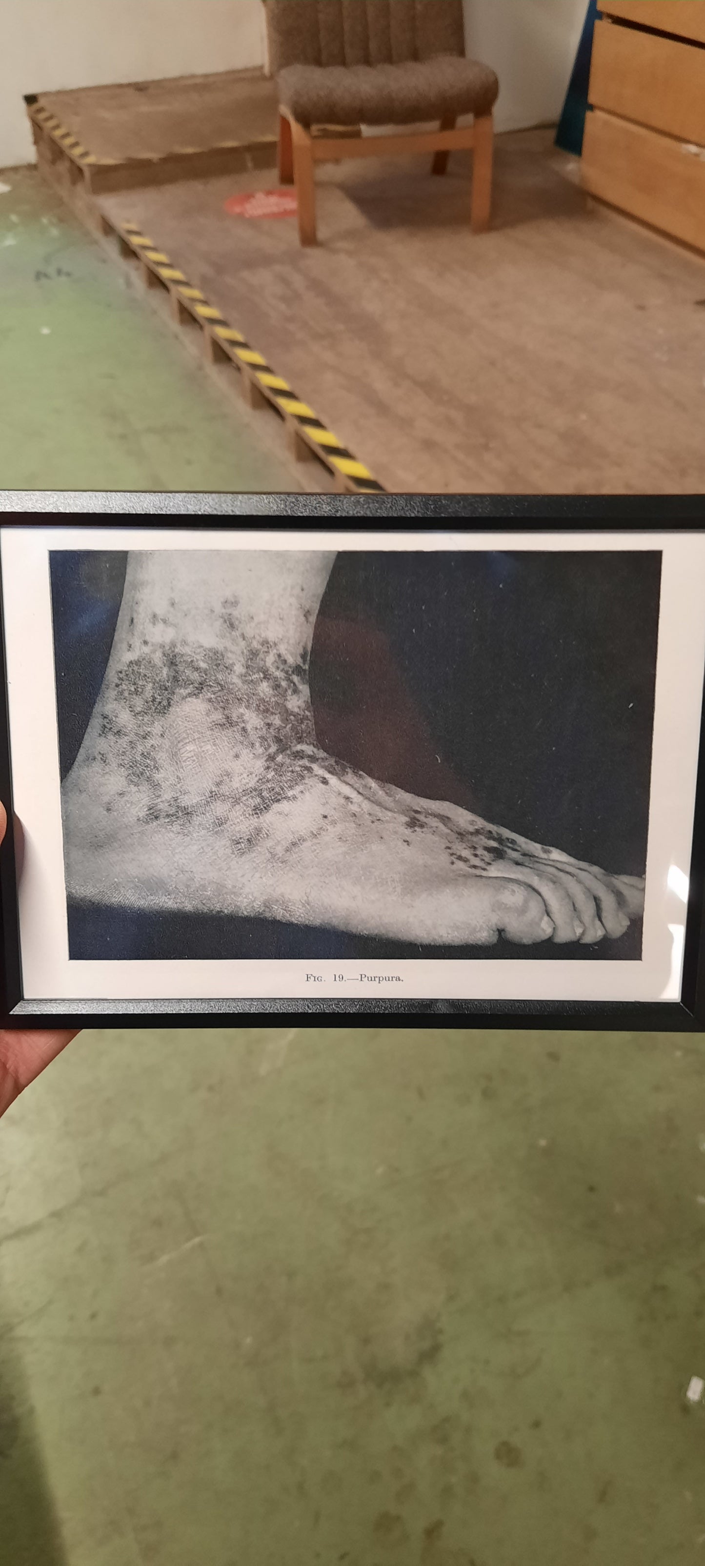 Framed Pages from an antique book on Skin Diseases