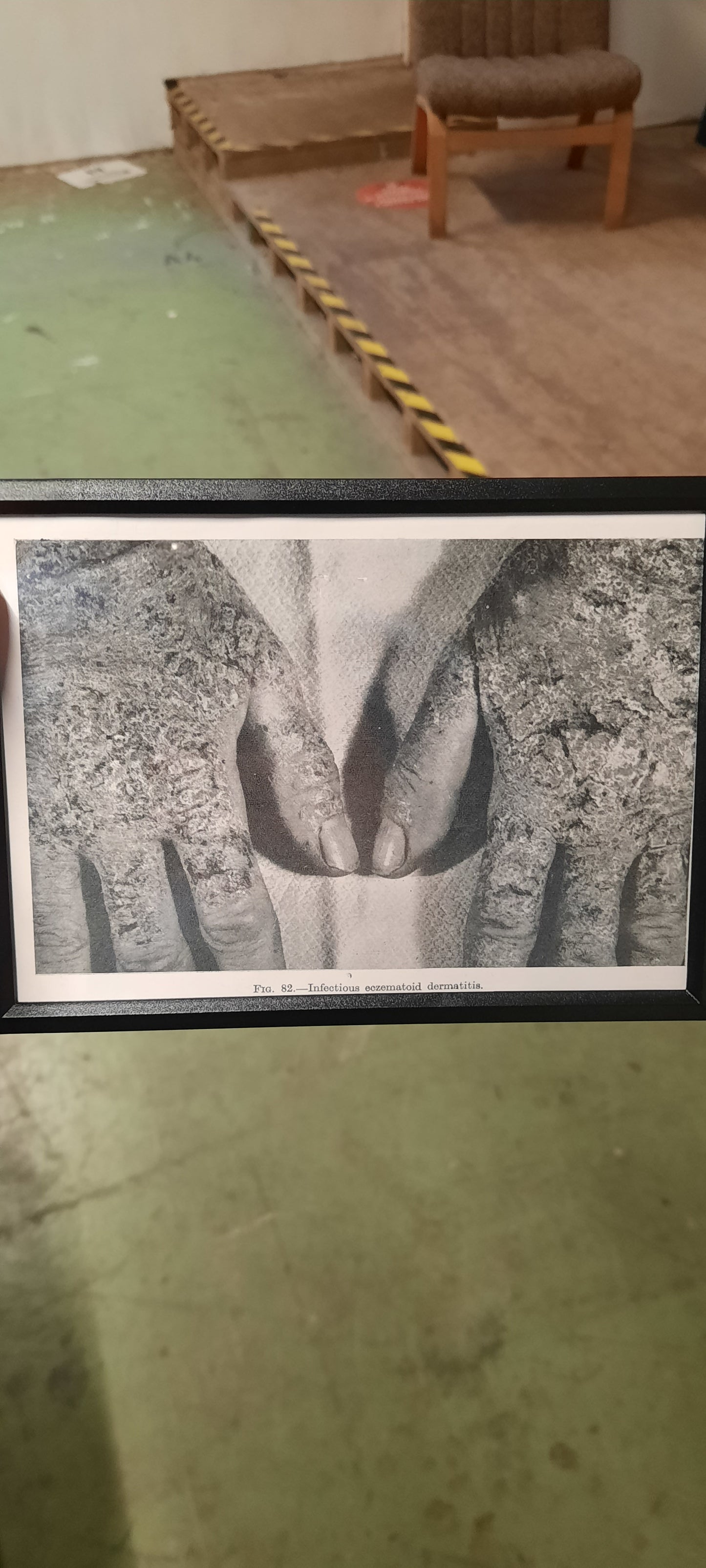 Framed Pages from an antique book on Skin Diseases
