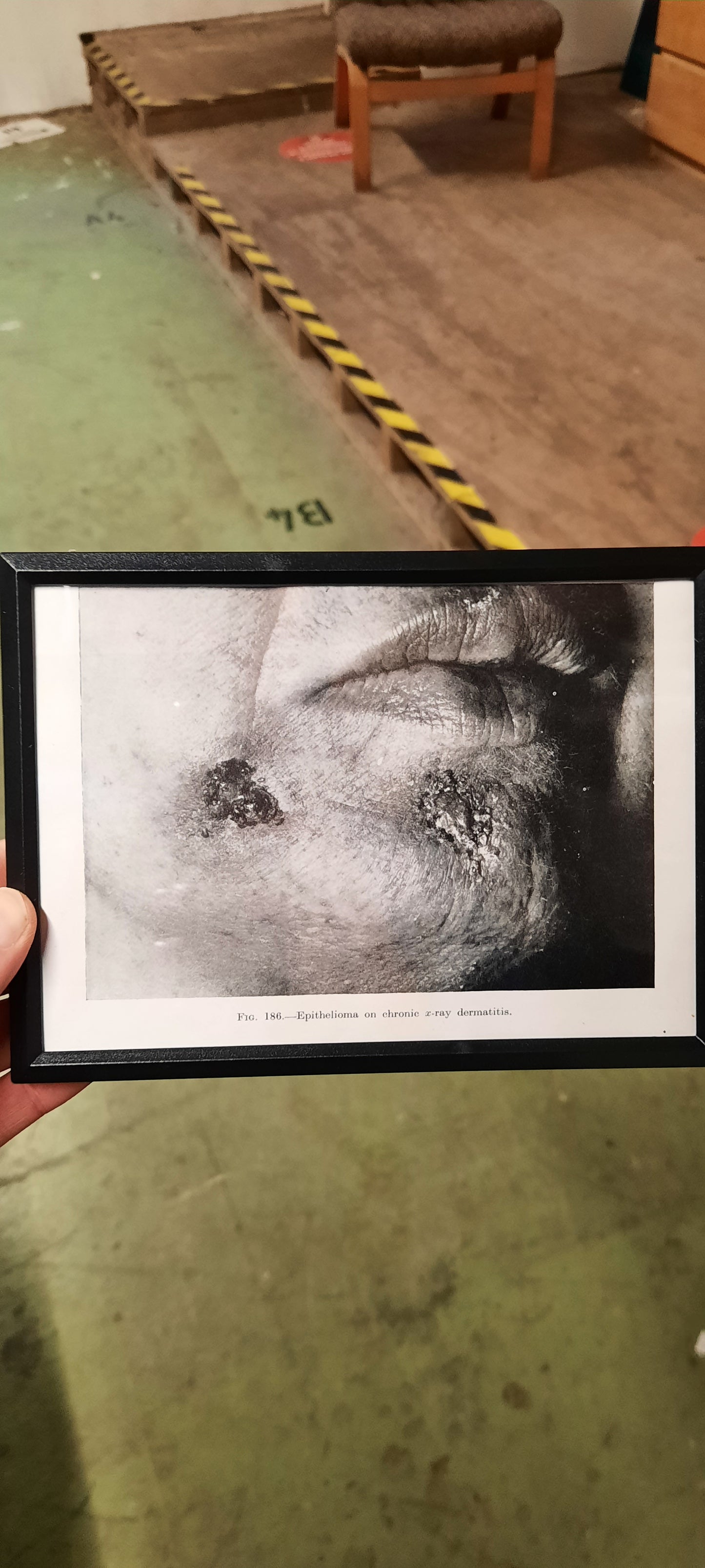 Framed Pages from an antique book on Skin Diseases