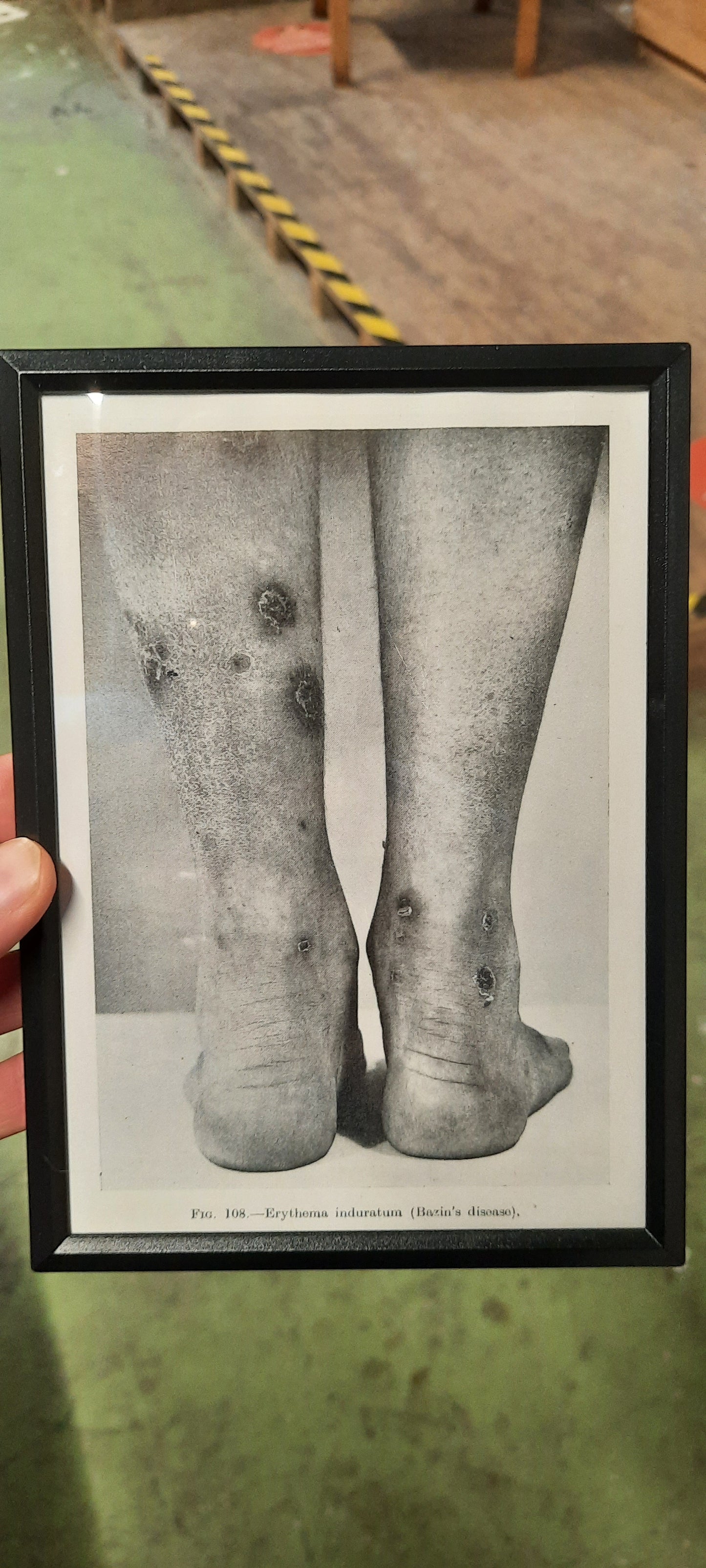 Framed Pages from an antique book on Skin Diseases