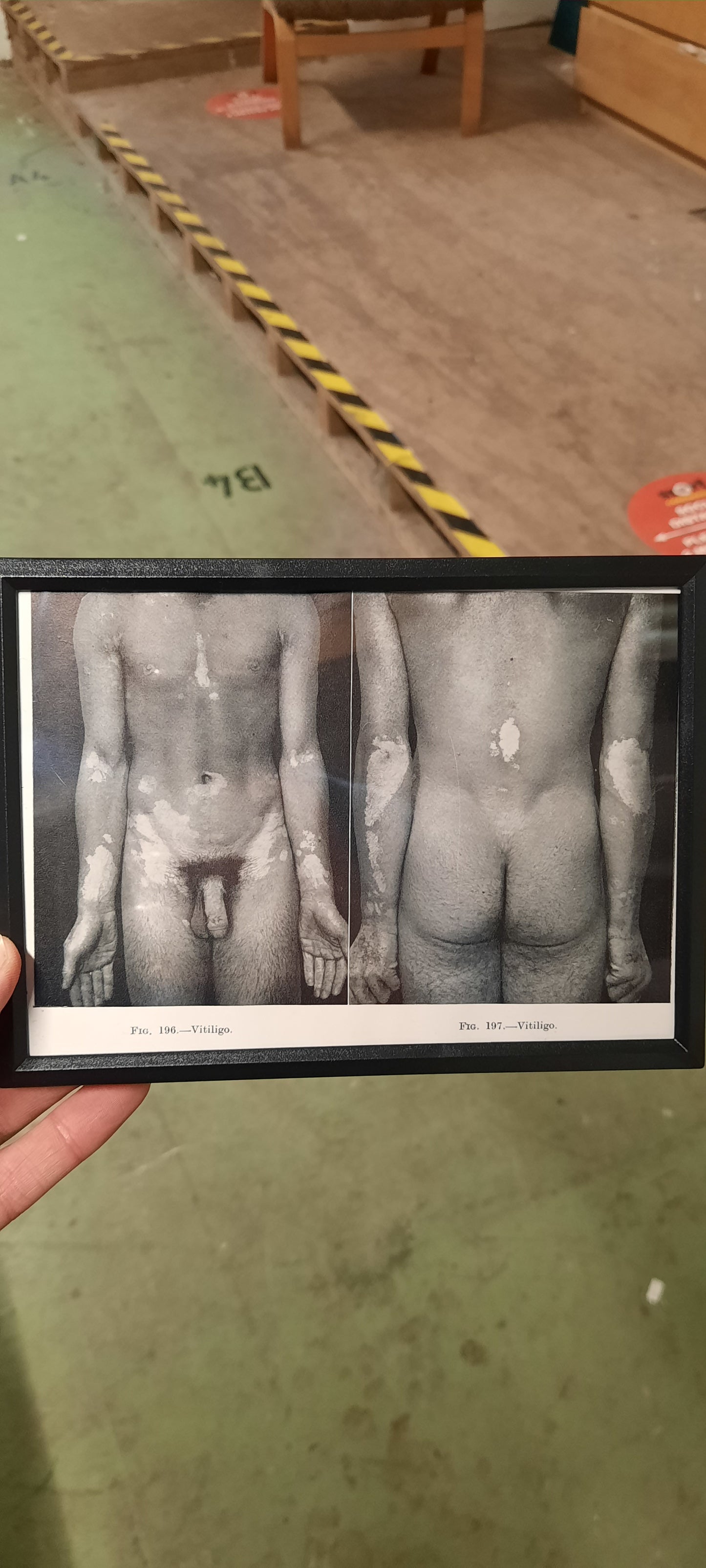 Framed Pages from an antique book on Skin Diseases