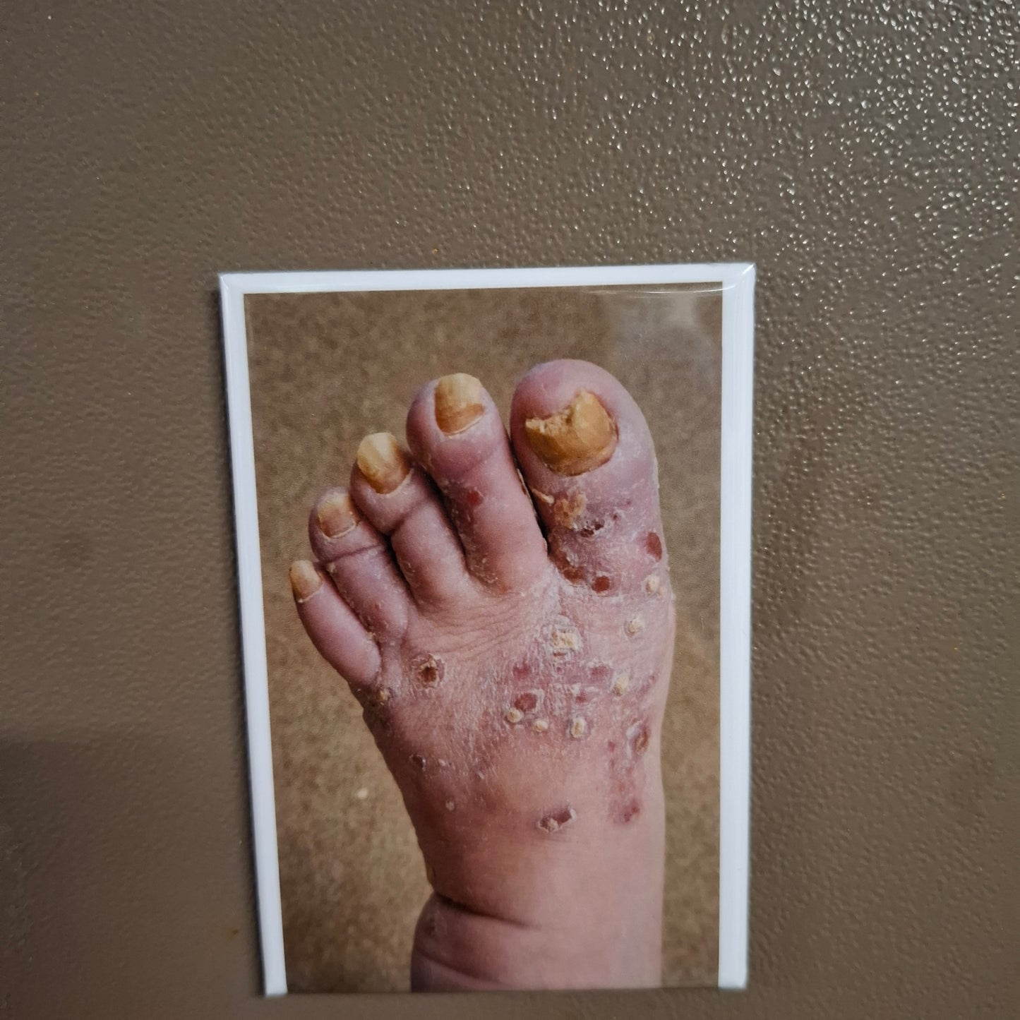 My Dad's Toes 2025 Update - Fridge Magnet